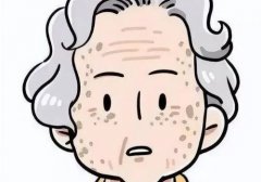 怎樣消除老年斑？診療方法有飲食調(diào)理、冷凍診療、點(diǎn)陣激光等等